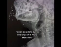 Wajah Pasien Dipenuhi Ratusan Susuk Terungkap melalui Hasil CT Scan yang Mengerikan