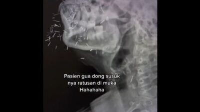 Wajah Pasien Dipenuhi Ratusan Susuk Terungkap melalui Hasil CT Scan yang Mengerikan